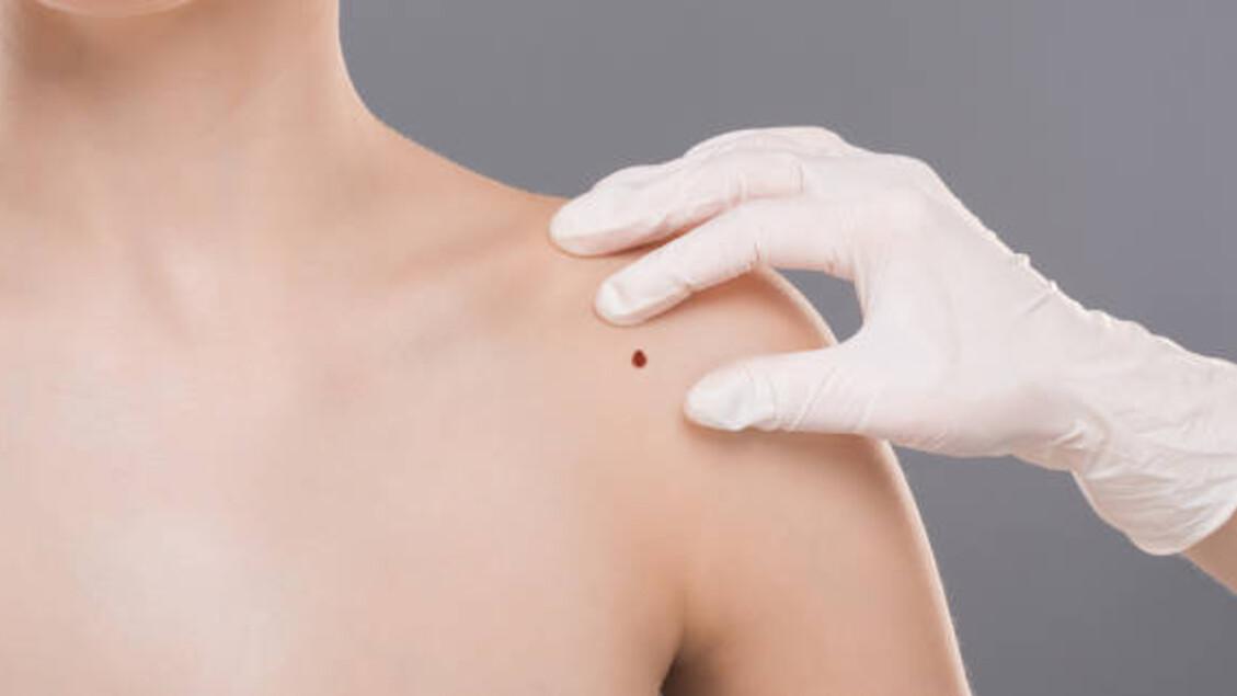 Mappatura della scomparsa Dermatologia - Salute -
